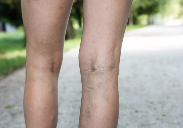 Different veins