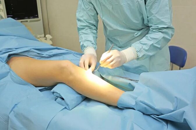 Flbectomy