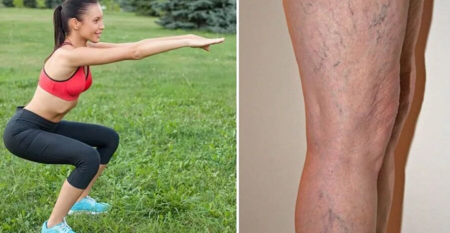 Varicose legs