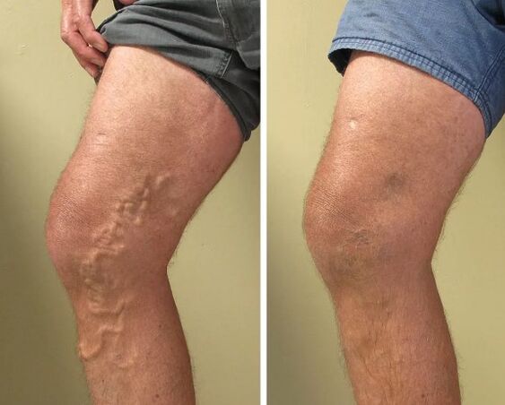 Varicose veins before and after treatment