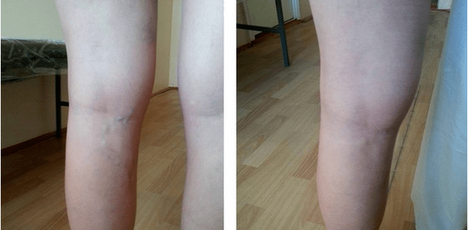 varicose veins