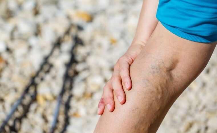 Varicose veins